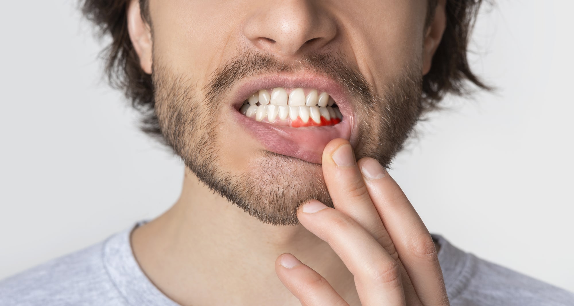 Six Ways To Prevent Receding Gums